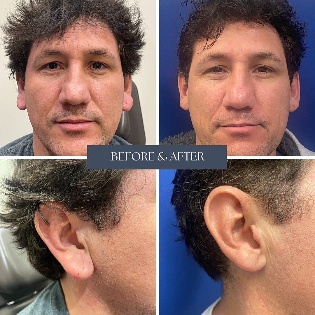 Ear Procedures Before & After