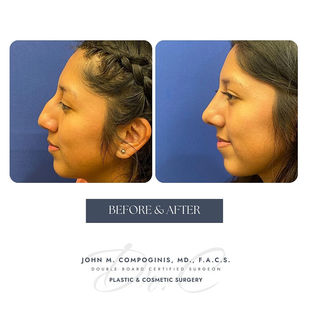 Rinoplastia Before & After