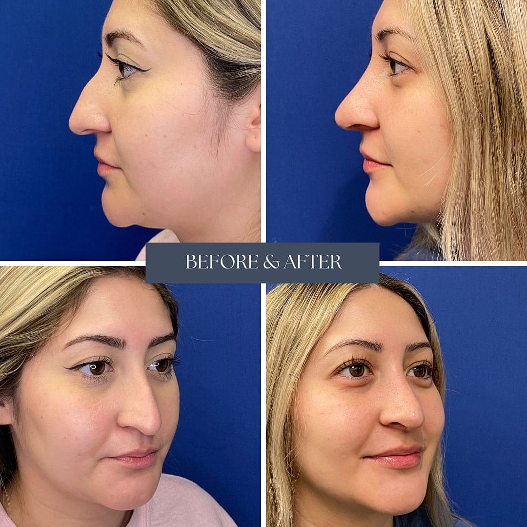 Rinoplastia Before & After