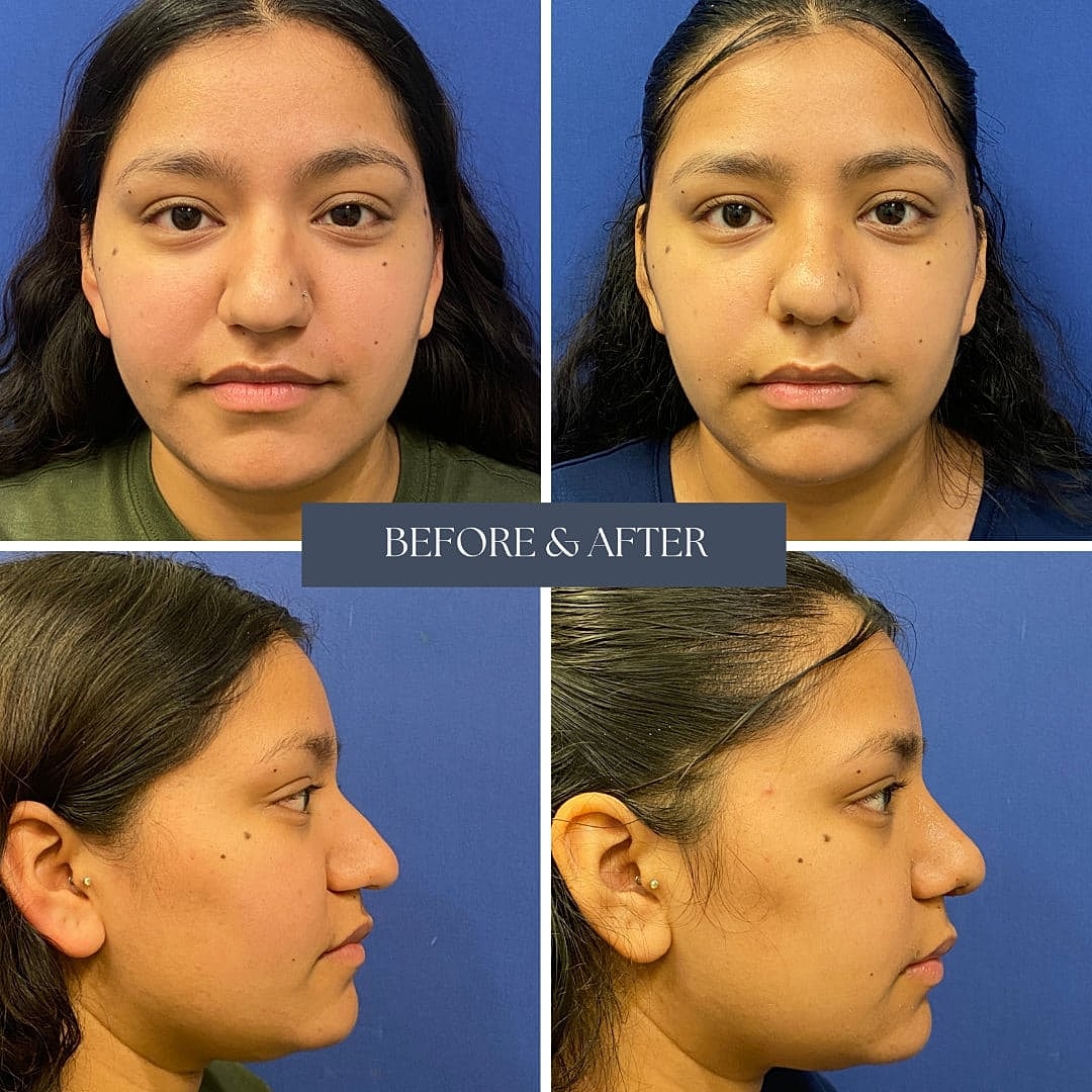 Rinoplastia Before & After