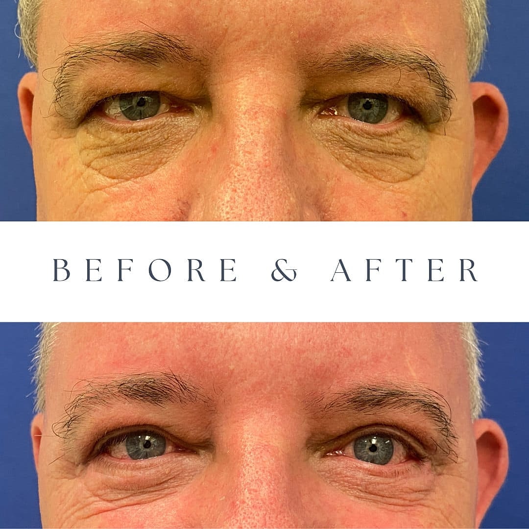 Blefaroplastia Before & After