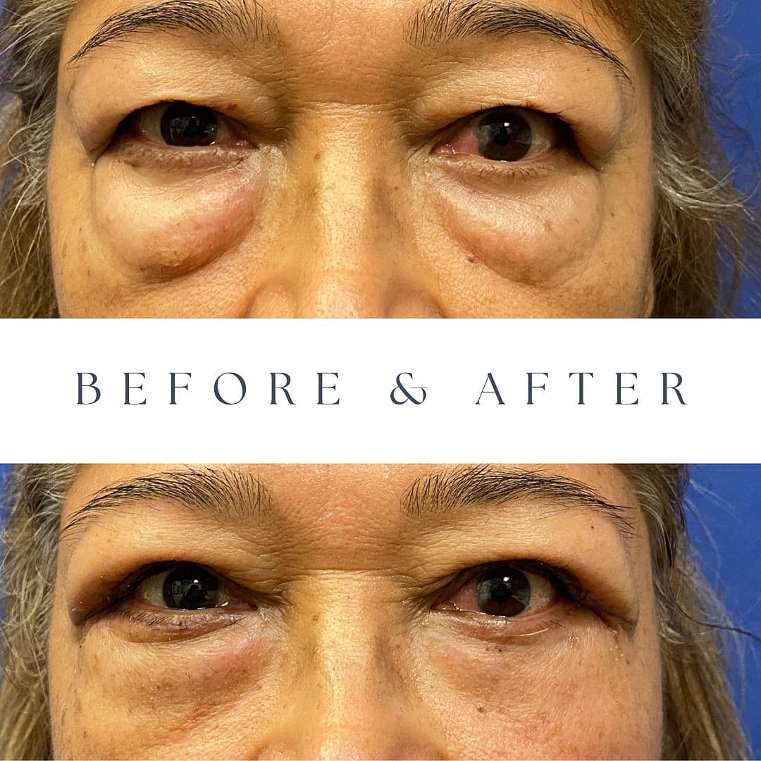 Blefaroplastia Before & After