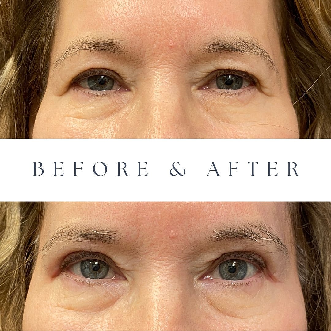 Blefaroplastia Before & After